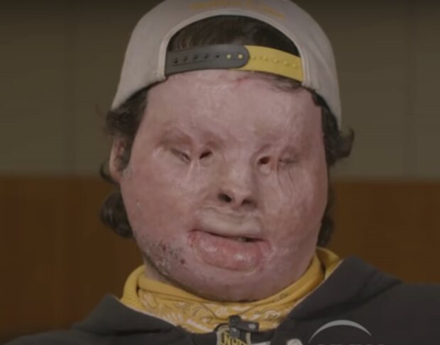 Amerykańscy lekarze po raz pierwszy w historii świata z sukcesem przeszczepili twarz oraz 2 ręce