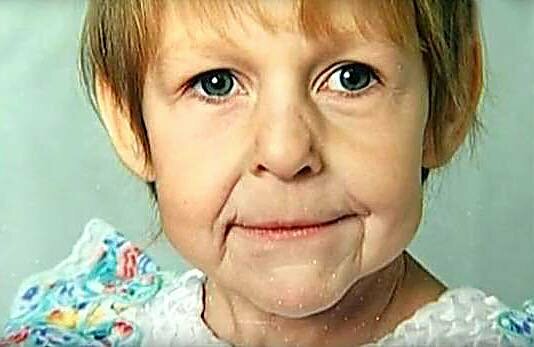 jak potoczył się los dziewczynki, która urodziła się ze „starą” twarzą