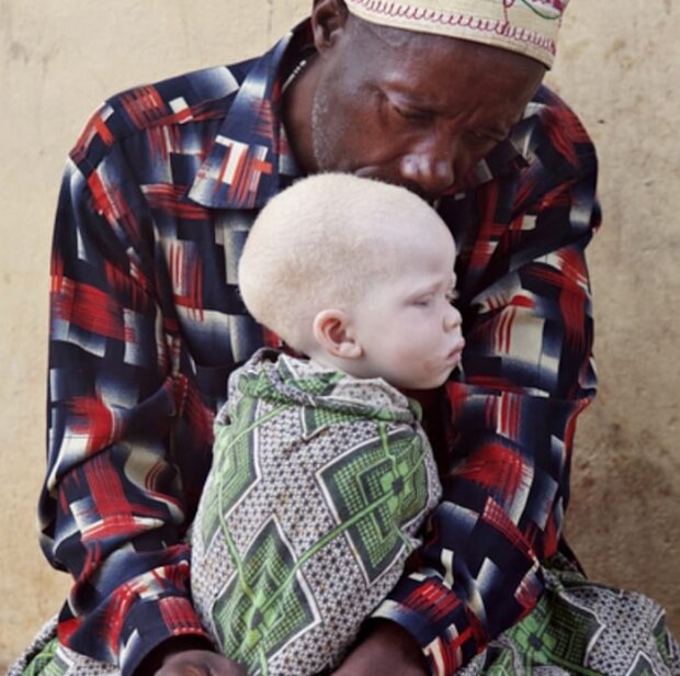 Dzieciaki z albinizmem