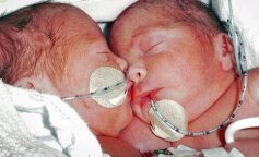 „Całkowicie zdrowe”: jak teraz wyglądają bliźnięta syjamskie, które zostały pomyślnie rozdzielone 7 lat temu