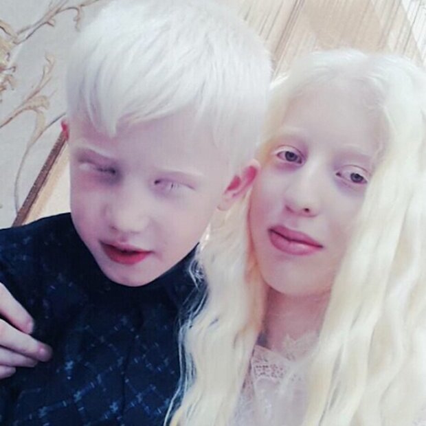 Dzieciaki z albinizmem