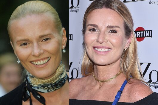 gwiazdy, które zrobiły sobie zęby