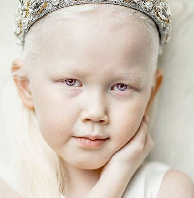 Dzieciaki z albinizmem